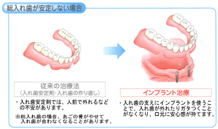 入れ歯が安定しない場合