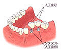 インプラント断面図