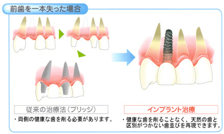 前歯を失った場合