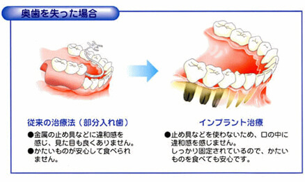 奥歯を失った場合